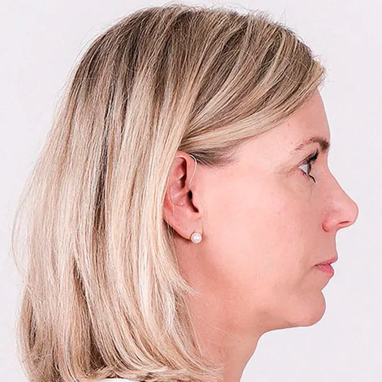 Bernafon Alpha XT miniRITE T İşitme Cihazı